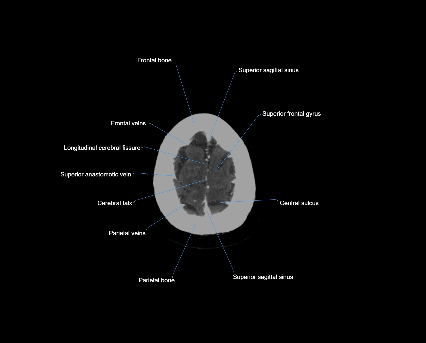 CT scan brain axial labelled cross sectional anatomy image-img-000067.webp